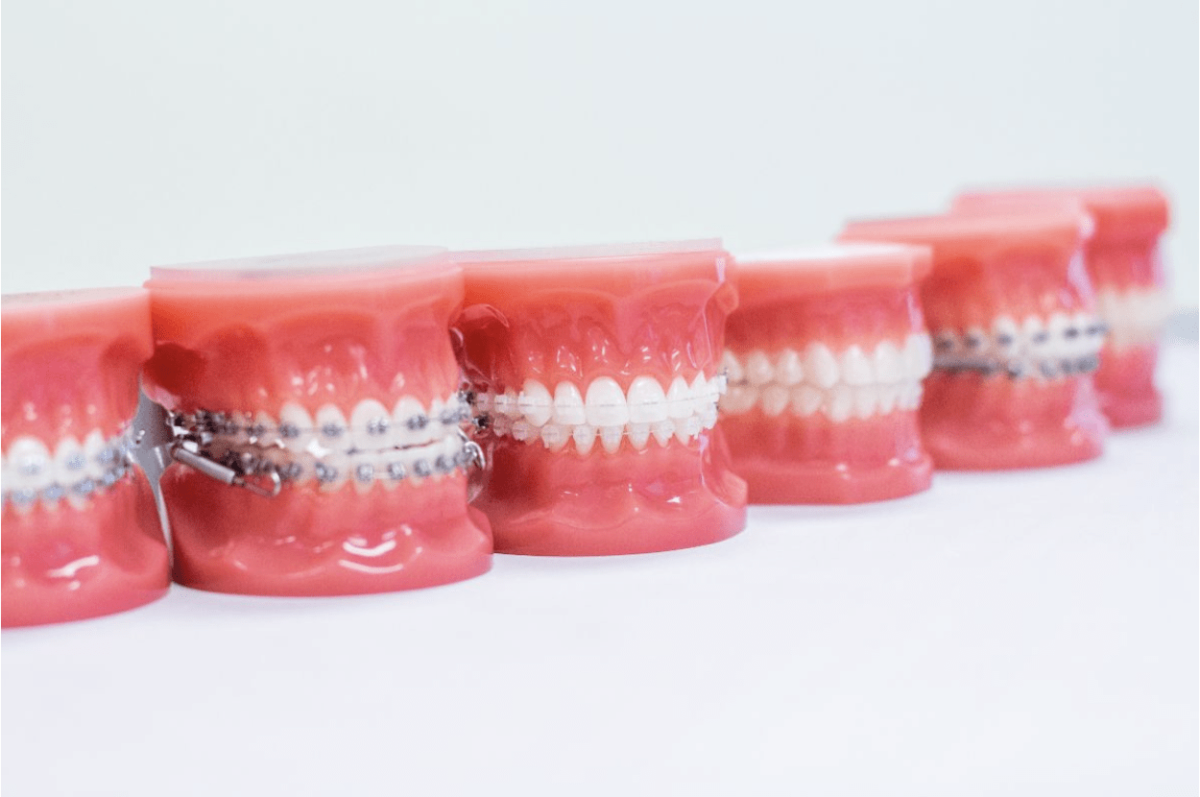 The Different Types of Braces